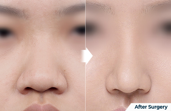 nose 152前后照片
