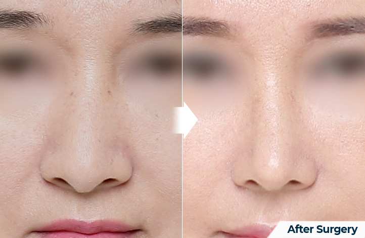nose 153前后照片