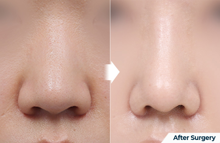 nose 154前后照片