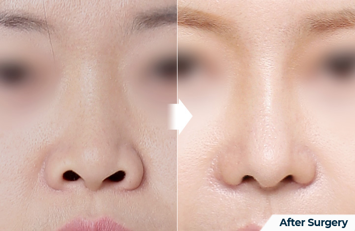 nose 155前后照片