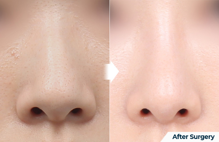 nose 156前后照片