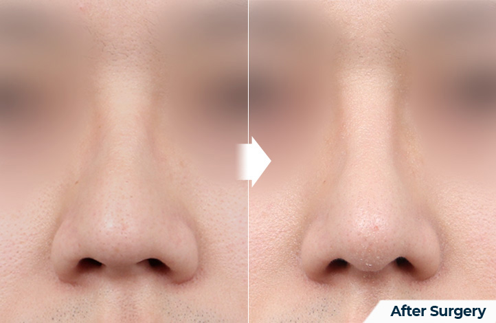 nose 157前后照片