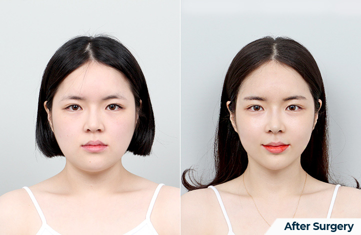 nose 158前后照片