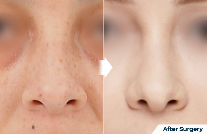 nose 159前后照片