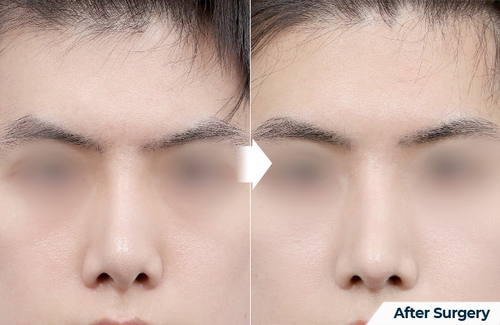 nose 160前后照片