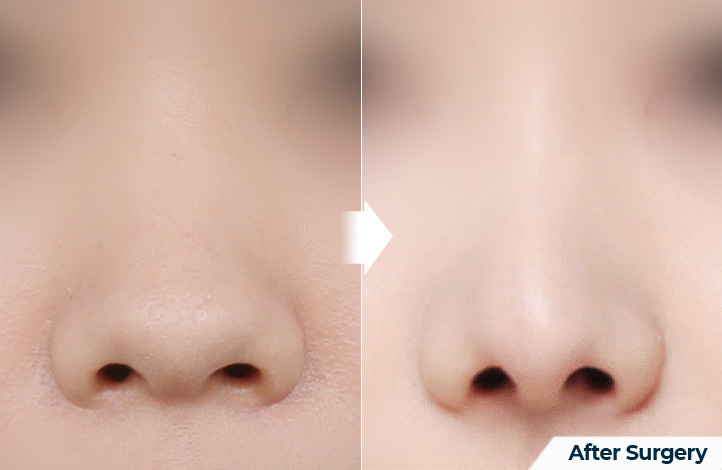 nose 170前后照片