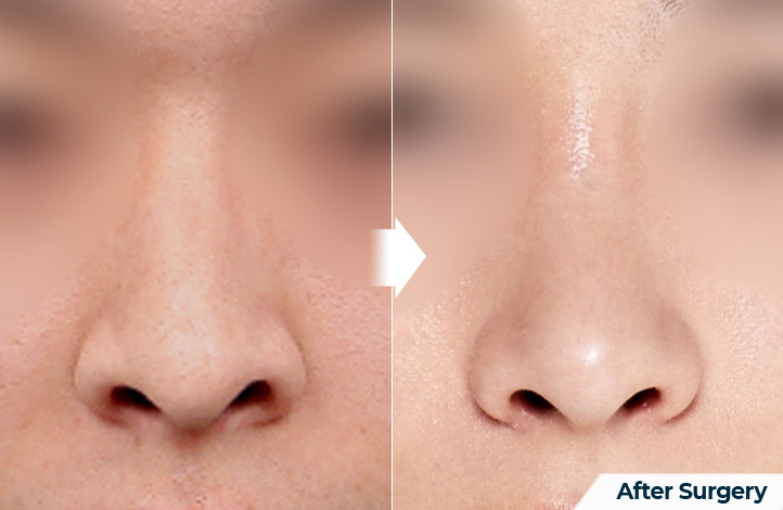 nose 171前后照片