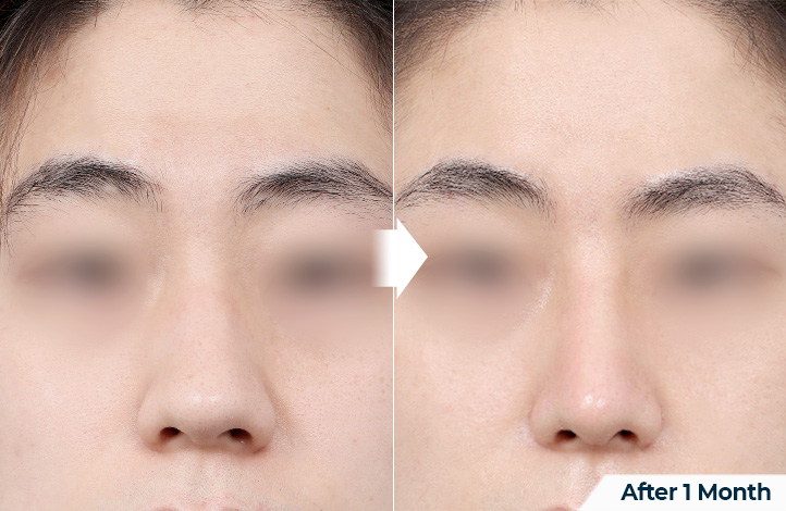 nose 172前后照片