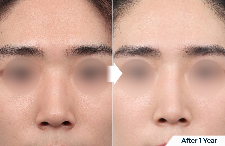 nose 173前后照片