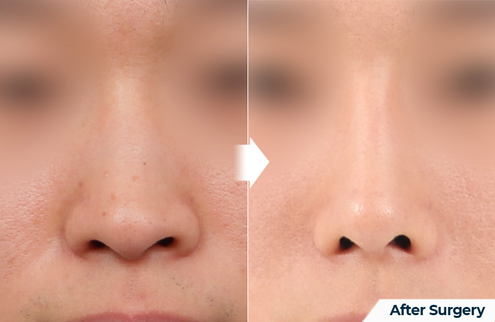 nose 174前后照片