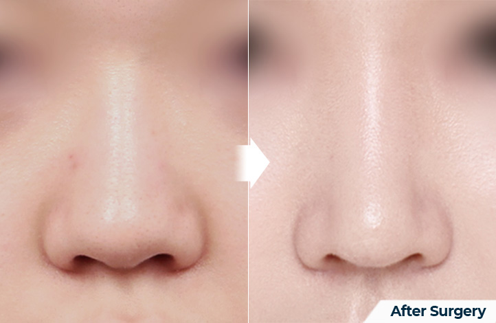 nose 175前后照片