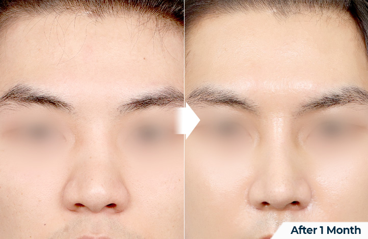 nose 176前后照片