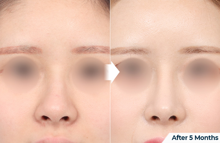 nose 178前后照片