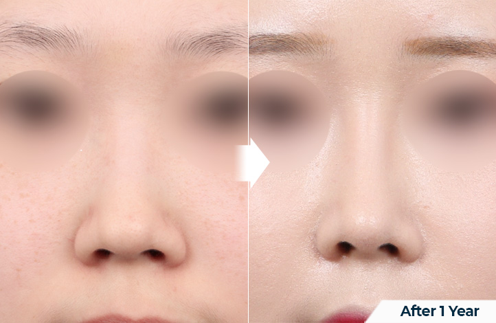 nose 180前后照片