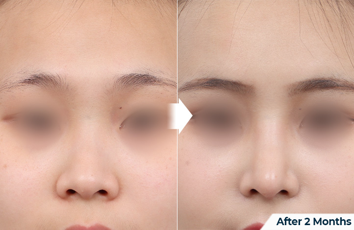 nose 181前后照片