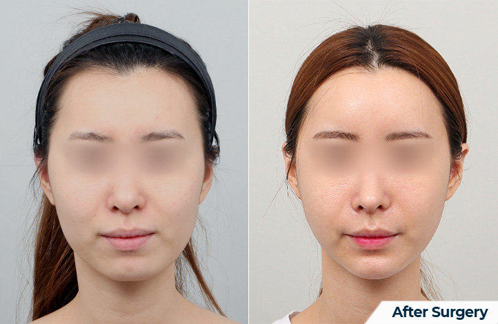 nose 184前后照片