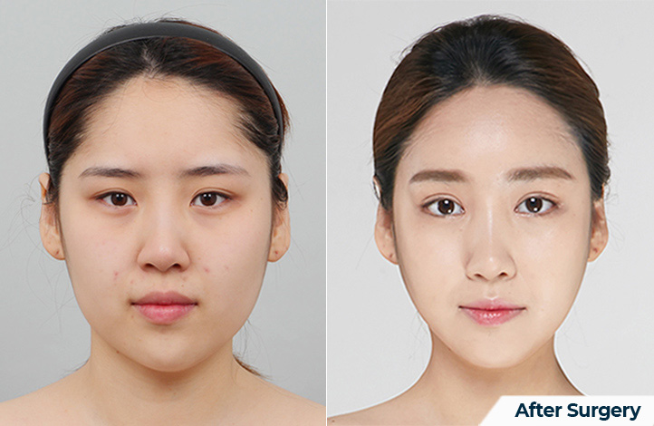 nose 185前后照片