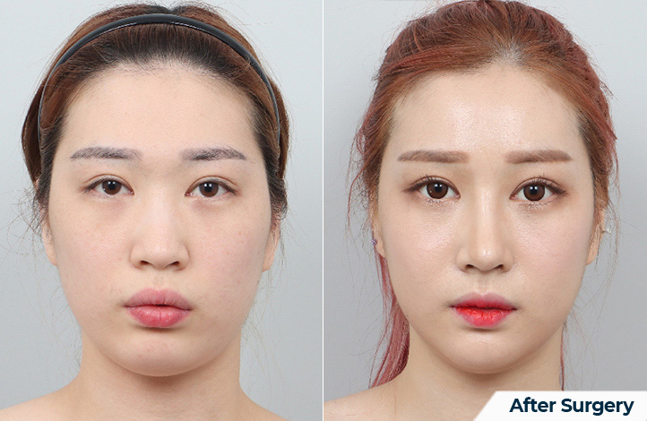 nose 186前后照片