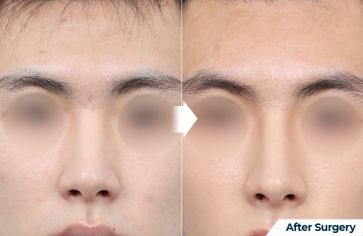 nose 187前后照片