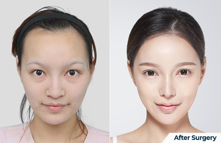 nose 189前后照片