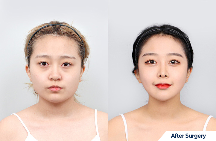 nose 190前后照片