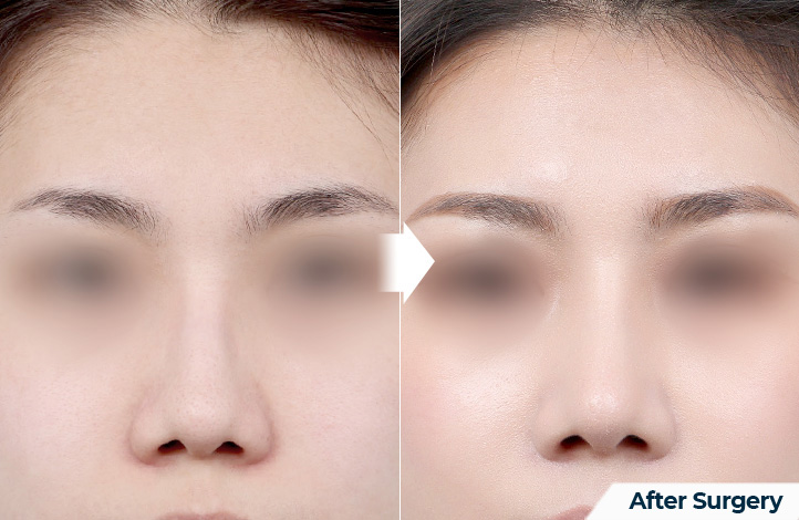 nose 192前后照片