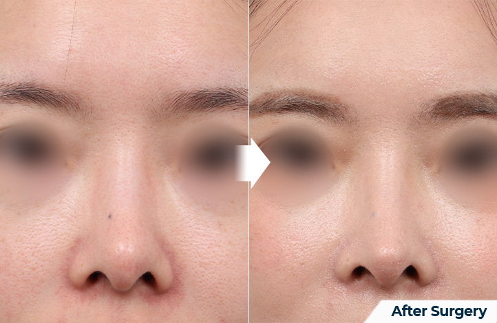 nose 193前后照片