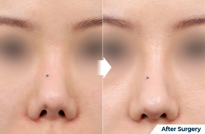 nose 194前后照片