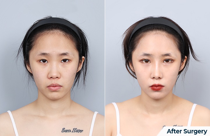 nose 195前后照片