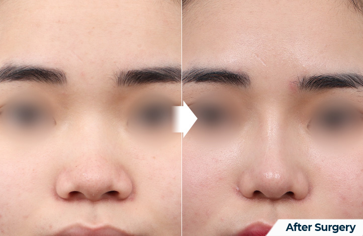 nose 196前后照片