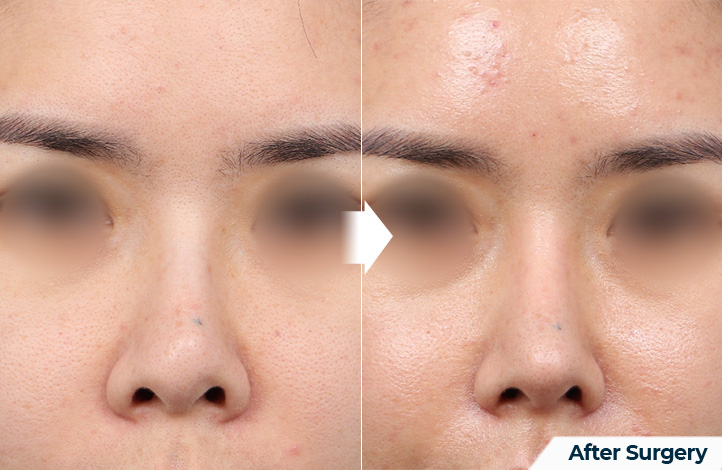 nose 197前后照片