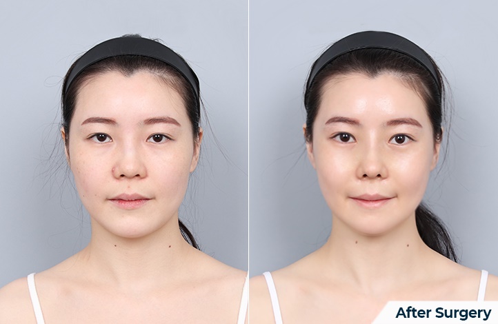 nose 198前后照片