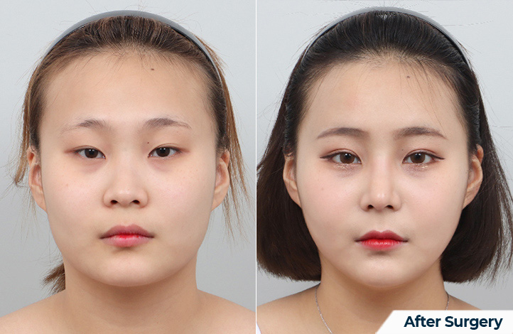 nose 200前后照片