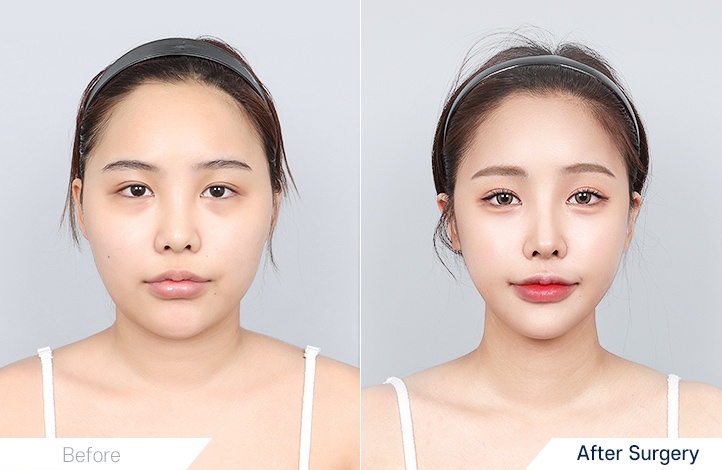 Facial contour 1前后照片