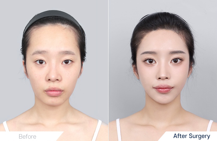 Facial contour 3前后照片