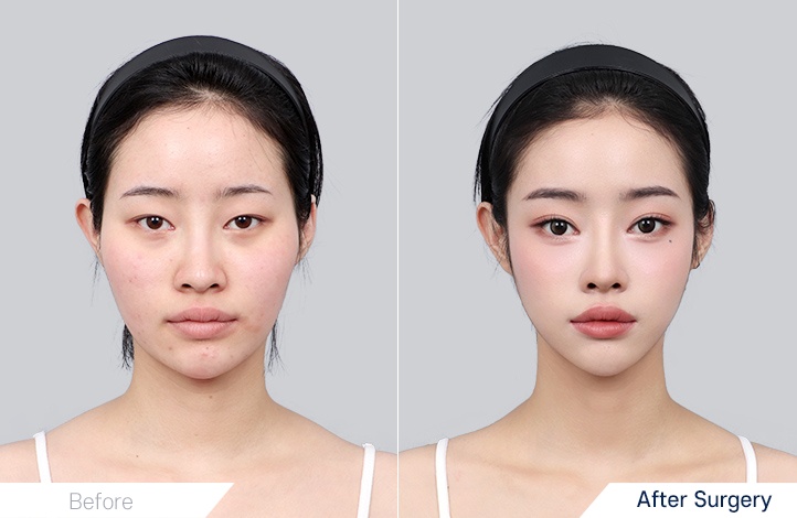 Facial contour 4前后照片