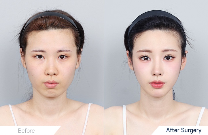 Facial contour 5前后照片