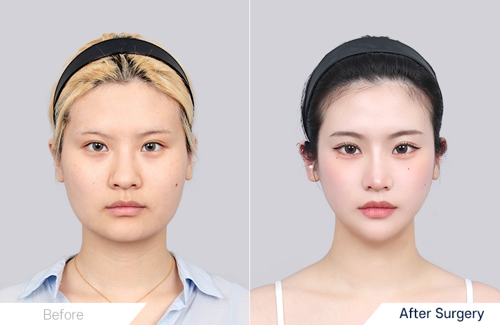 Facial contour 6前后照片