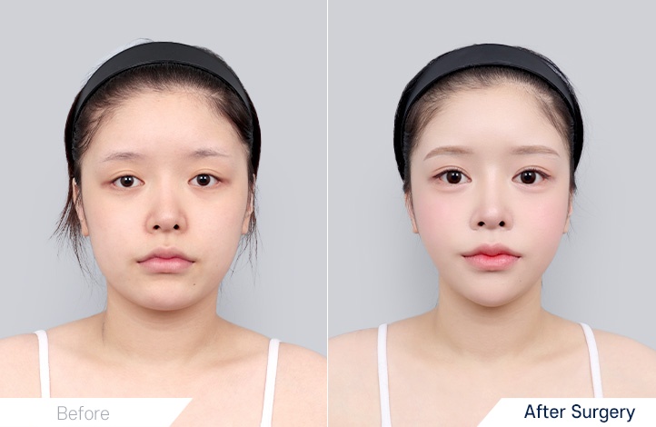 Facial contour 7前后照片