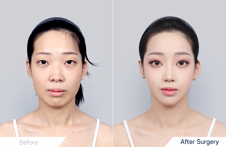 Facial contour 8前后照片