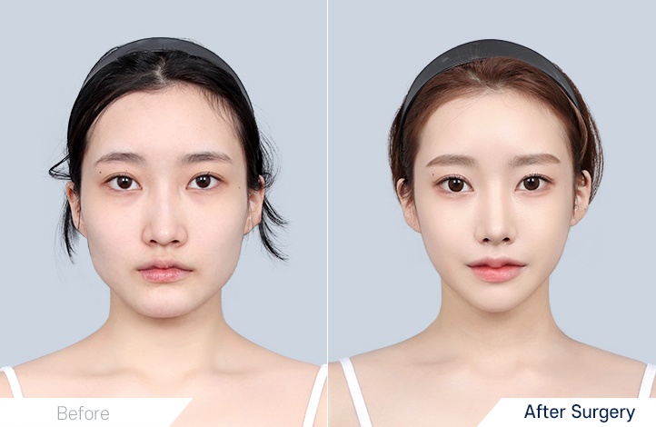 Facial contour 9前后照片