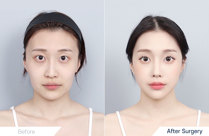 Facial contour 10前后照片