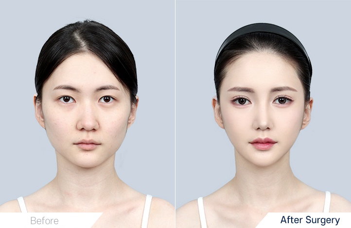 Facial contour 11前后照片