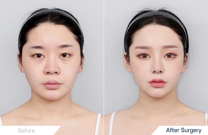 Facial contour 12前后照片