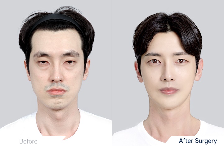 Facial contour 13前后照片