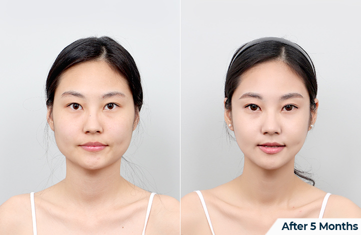 Facial contour 14前后照片
