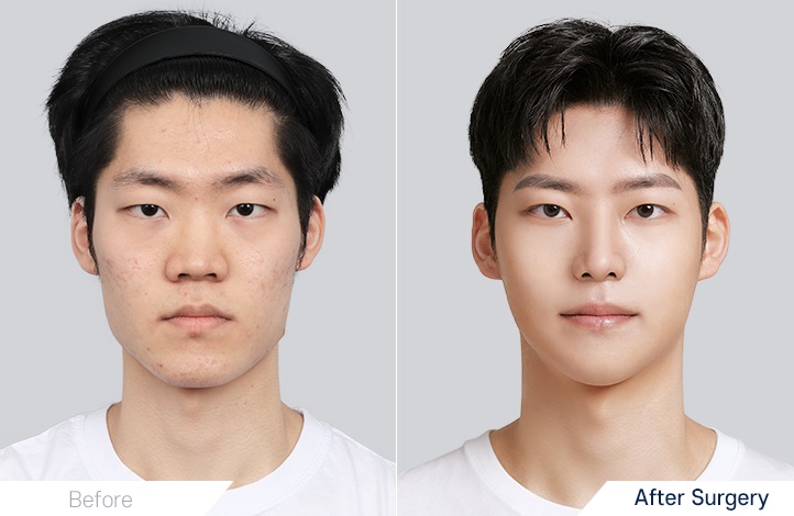 Facial contour 15前后照片