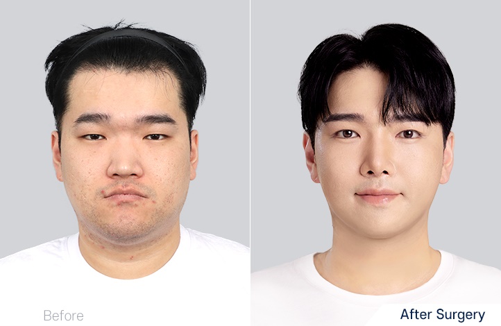 Facial contour 16前后照片