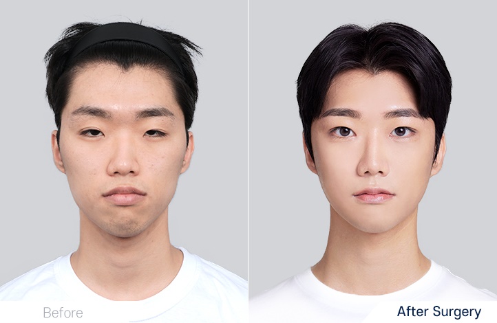 Facial contour 17前后照片