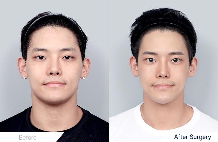 Facial contour 19前后照片